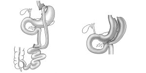 Tüp Mide mi Gastrik Bypass mı