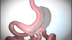Tüp Mide Ameliyatı