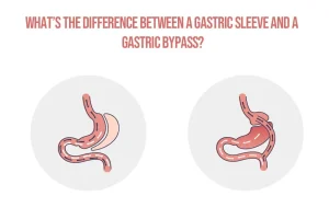 Gastrik Bypass Nedir? 2026 Rehberi: Ankara Obezite Cerrahisi ve Farkları