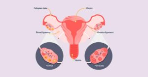 Kadınlarda PCOS ve Obezite İlişkisi 2026: Kilo Vermeyi Zorlaştıran Hormonal Nedenler Nelerdir? - Doç. Dr. Osman Yıldırım