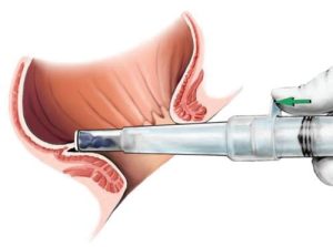 Ameliyatsız Hemoroid (Basur) Tedavisi 2026 - Doç. Dr. Osman Yıldırım