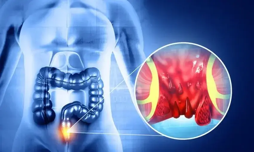 Hemoroid (Basur) Neden Olur? Ankara’da Tedavi ve Doktor Seçimi