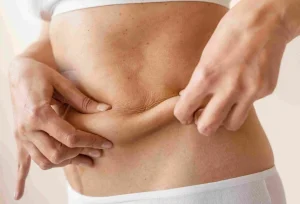 Obezite Cerrahisi Sonrası Sarkan Deri Nasıl Önlenir? 2026 Rehberi – Doç. Dr. Osman Yıldırım