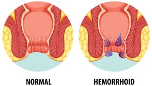 Hemoroid (Basur) Neden Olur? 2026 Rehberi: Ankara'da Tedavi ve Doktor Seçimi