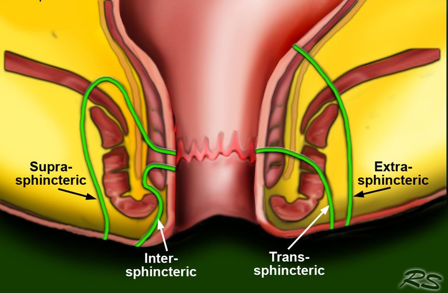 Perianal Fistül (Makat Fistülü) Nedir, Belirtileri Nelerdir? Kendiliğinden Geçer mi? – Doç. Dr. Osman Yıldırım