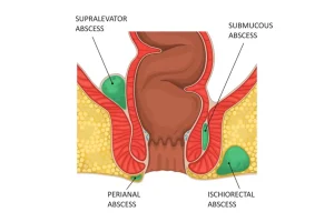 Perianal Fistül (Makat Fistülü) Nedir, Belirtileri Nelerdir? Kendiliğinden Geçer mi? – Doç. Dr. Osman Yıldırım